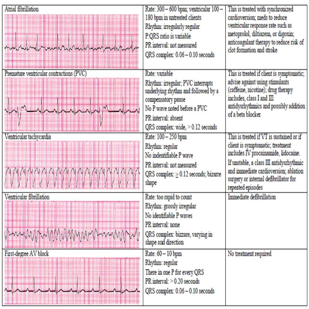 printable ekg cheat sheet